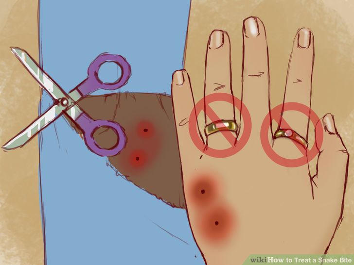 aid345753-728px-Treat-a-Snake-Bite-Step-5-Version-4